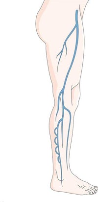 an illustration of a vein in the leg